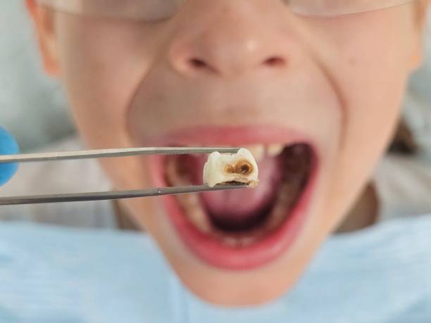 Best Emergency Treatment for Dental Infections or Abscesses in La Vergne, TN